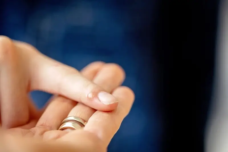 Co na kurzajki na stopie?