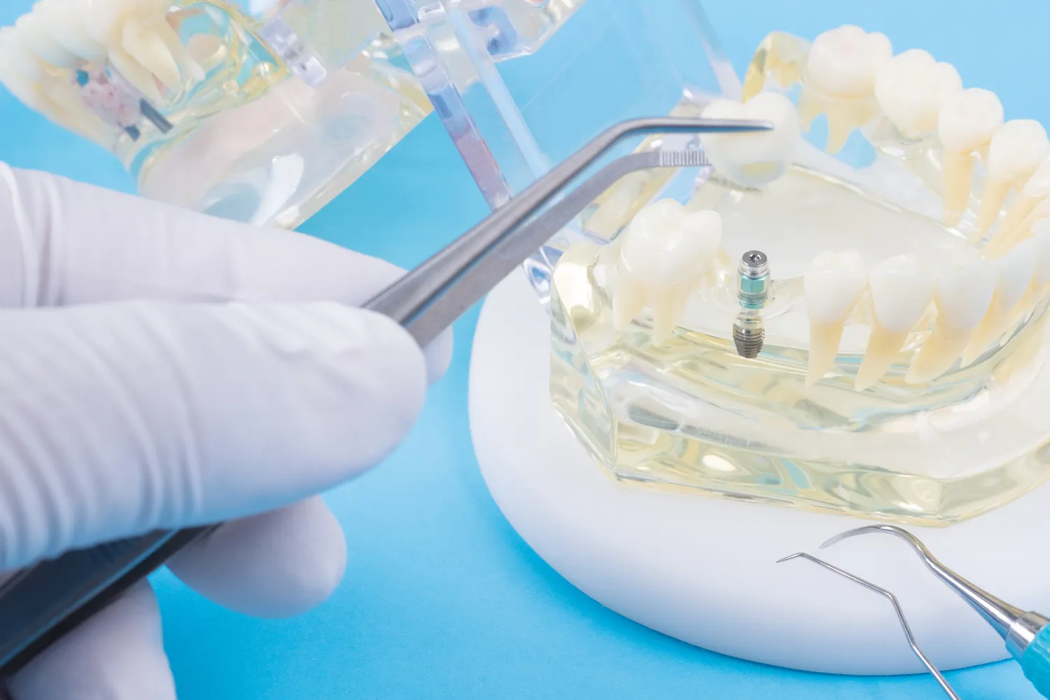 Ile kosztuje wstawienie zęba 1?