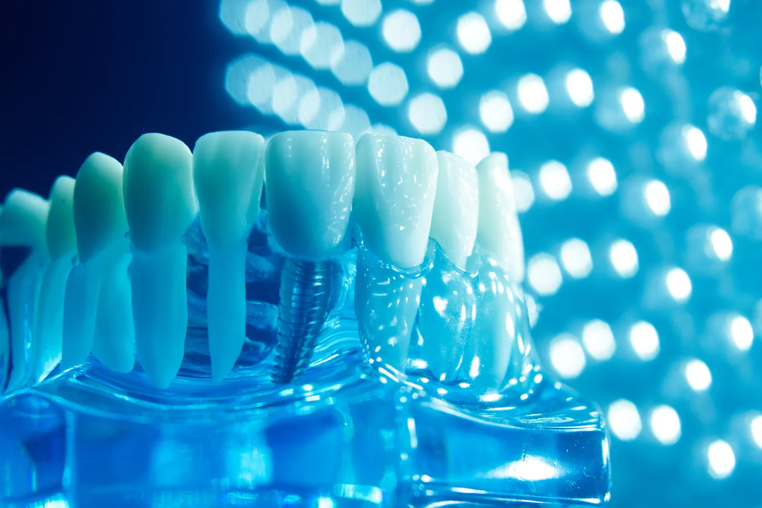 Implanty zębów cała szczęka cena Warszawa