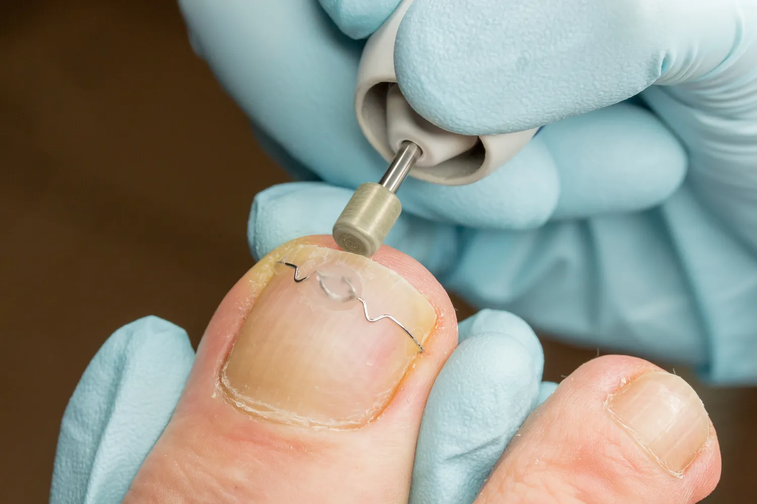 Podologia - sposób na zdrowe i piękne stopy